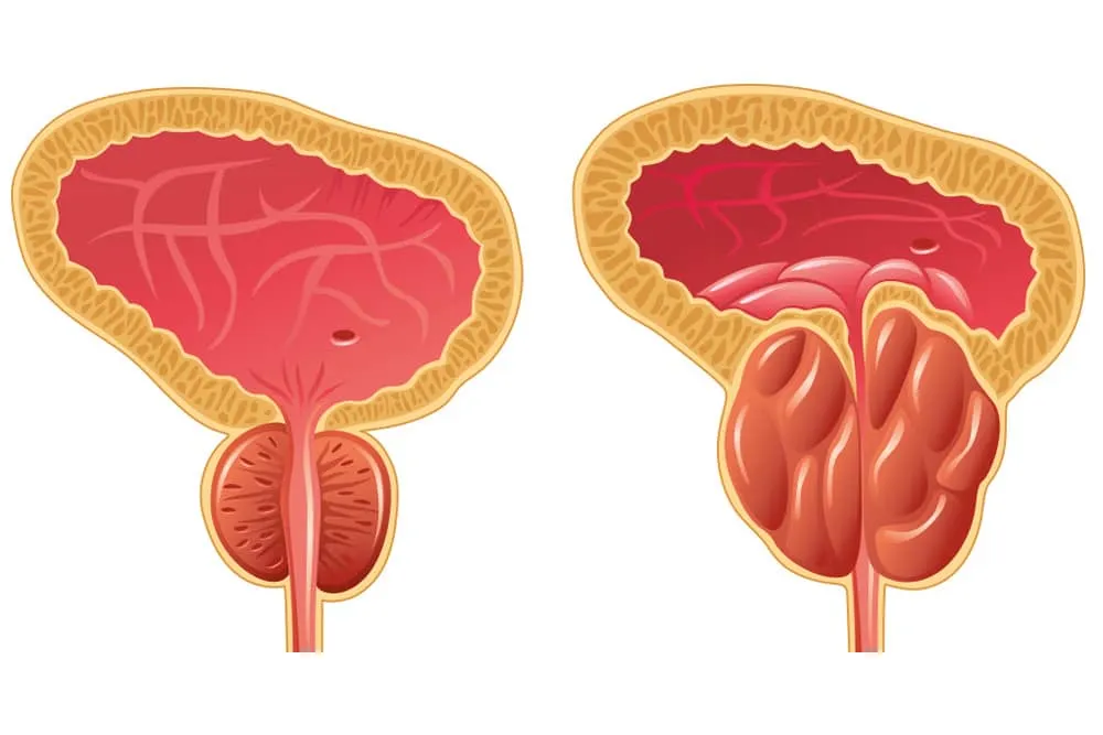 Аденома простаты: симптомы и лечение
