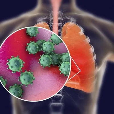 Как отличить коронавирус от ОРВИ, грипп и других заболеваний
