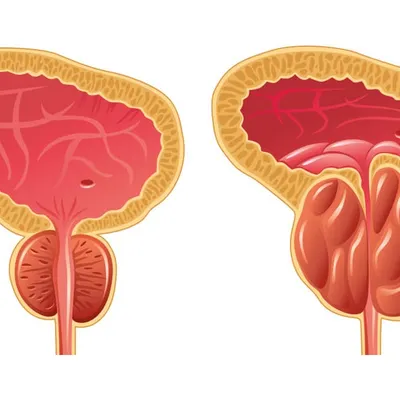 Аденома простаты: симптомы и лечение