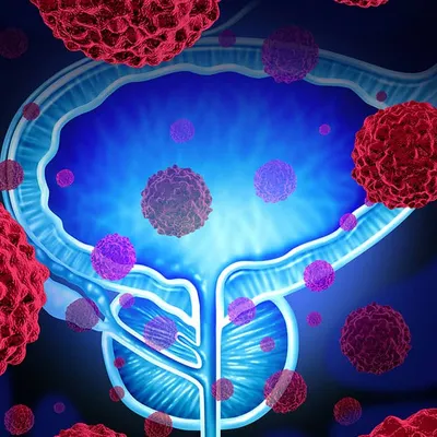 Рак предстательной железы: признаки, стадии, терапия