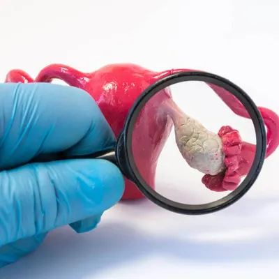 Синдром поликистозных яичников (СПКЯ): признаки, лечение